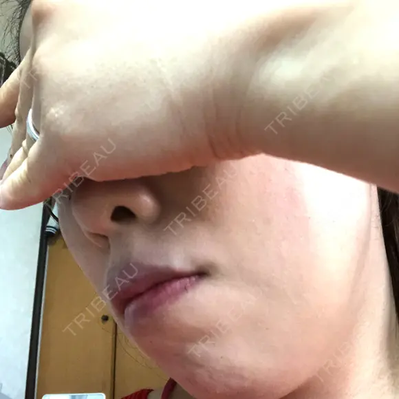 ピーリング（ニキビ・毛穴） 自由が丘クリニック DAY 22 メイン用