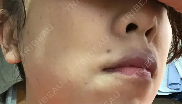 ピーリング（ニキビ・毛穴） 自由が丘クリニック DAY 22 メイン用