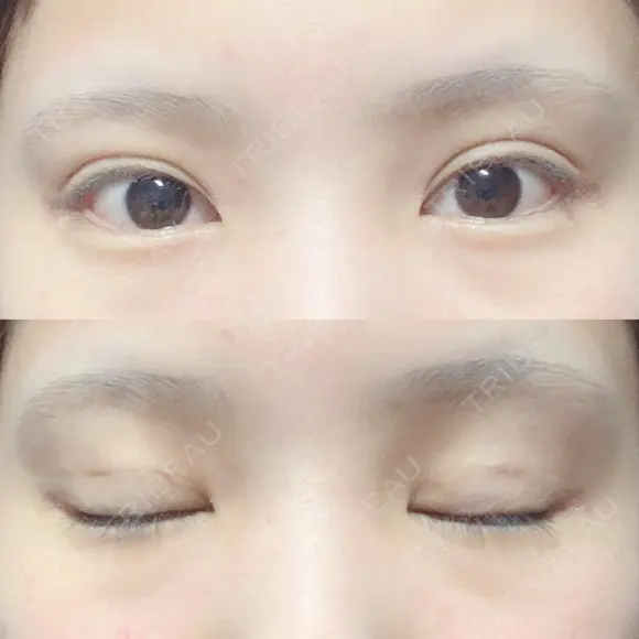 二重埋没 ビスポーククリニック 福岡院 DAY 40 メイン用