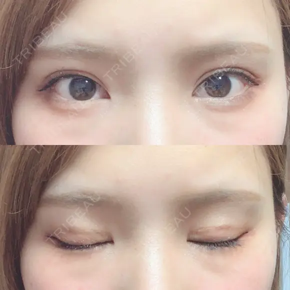 二重埋没 ビスポーククリニック 福岡院 DAY 40 メイン用