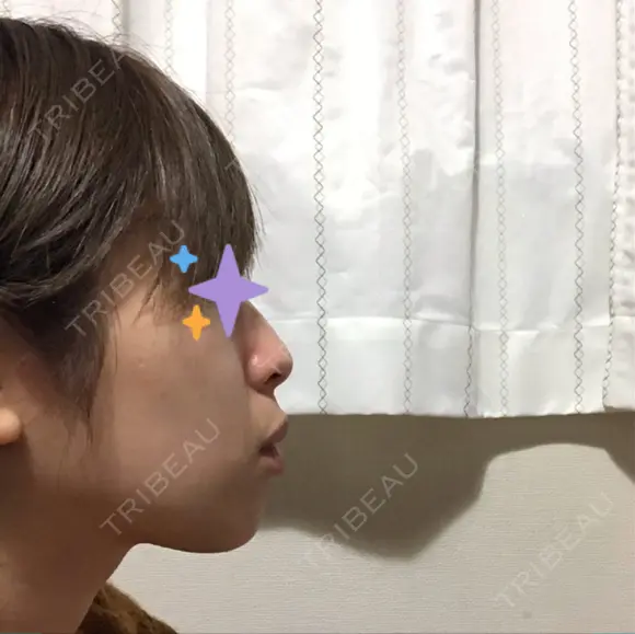 脂肪溶解注射（顔） 赤坂プレミアクリニック DAY 8 メイン用