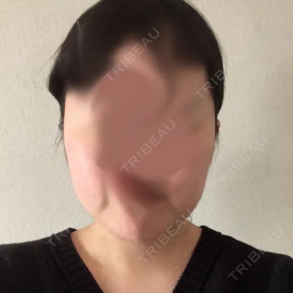 骨切り（あご） ボンディ美容整形外科（旧リオン整形外科） DAY 91 メイン用