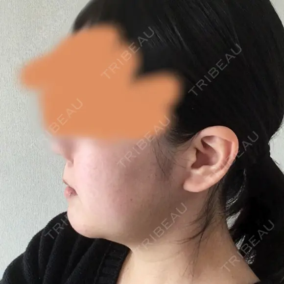 骨切り（あご） ボンディ美容整形外科（旧リオン整形外科） DAY 91 メイン用