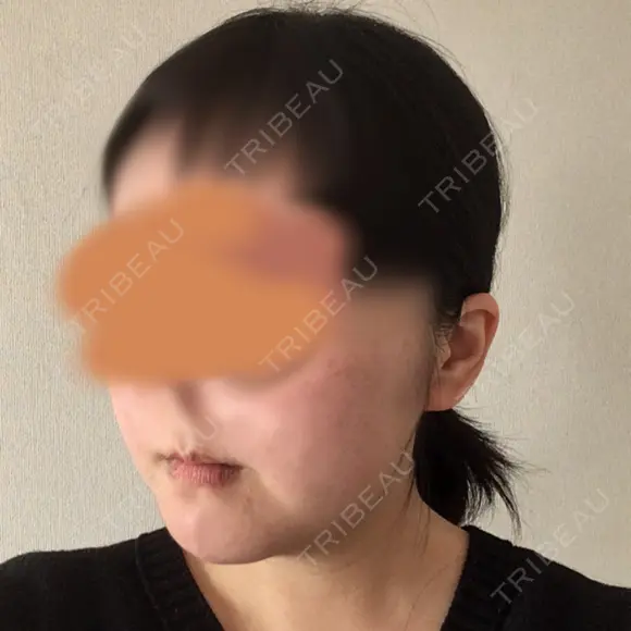 骨切り（あご） ボンディ美容整形外科（旧リオン整形外科） DAY 91 メイン用