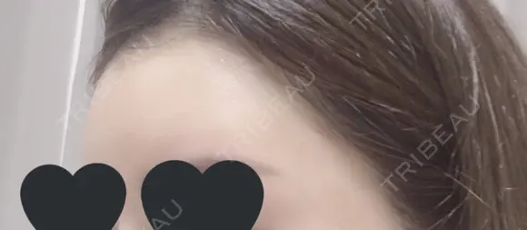 額を丸く / 脂肪注入（額） / ヒアルロン酸注入（額） / その他（輪郭） エートップ美容整形外科 DAY 11 メイン用
