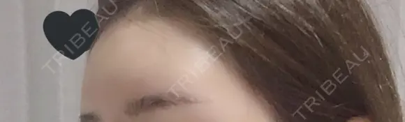 額を丸く / 脂肪注入（額） / ヒアルロン酸注入（額） / その他（輪郭） エートップ美容整形外科 DAY 10 メイン用