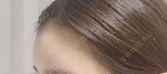 額を丸く / 脂肪注入（額） / ヒアルロン酸注入（額） / その他（輪郭） エートップ美容整形外科 DAY 9 メイン用