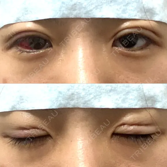 二重埋没 湘南美容クリニック 松山院 DAY 0 メイン用