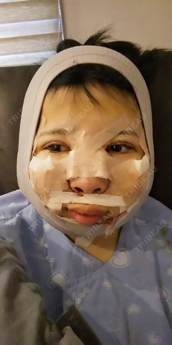 二重埋没 / 目頭切開 / 眼瞼下垂（切開） / 隆鼻術 / 鼻尖形成（切開） / 鼻中隔延長（切開） / 骨切り（あご） / 骨削り（エラ） / 骨削り（頬） / 骨切幅寄せ ボンディ美容整形外科（旧リオン整形外科） DAY 2 メイン用