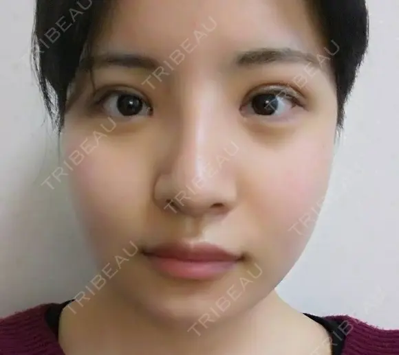 二重埋没 / 目頭切開 / 眼瞼下垂（切開） / 隆鼻術 / 鼻尖形成（切開） / 鼻中隔延長（切開） / 骨切り（あご） / 骨削り（エラ） / 骨削り（頬） / 骨切幅寄せ ボンディ美容整形外科（旧リオン整形外科） DAY 31 メイン用