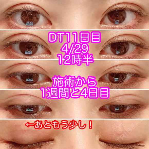 二重埋没 ビスポーククリニック 福岡院 DAY 11 メイン用