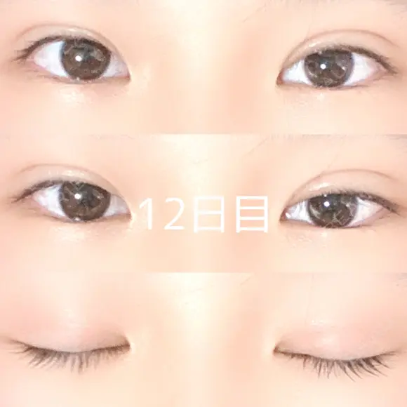 二重埋没 / 上まぶたの脂肪取り 品川スキンクリニック沖縄院 DAY 12 メイン用