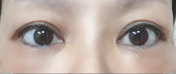 下まぶたたるみ取り セオリークリニック AFTER メイン用