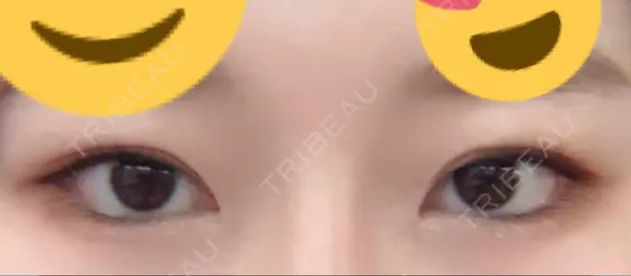 目頭切開 / 下まぶたの脂肪取り / タレ目形成・グラマラスライン（切開） ララ整形外科 DAY 41 メイン用