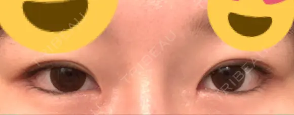 目頭切開 / 下まぶたの脂肪取り / タレ目形成・グラマラスライン（切開） ララ整形外科 DAY 61 メイン用