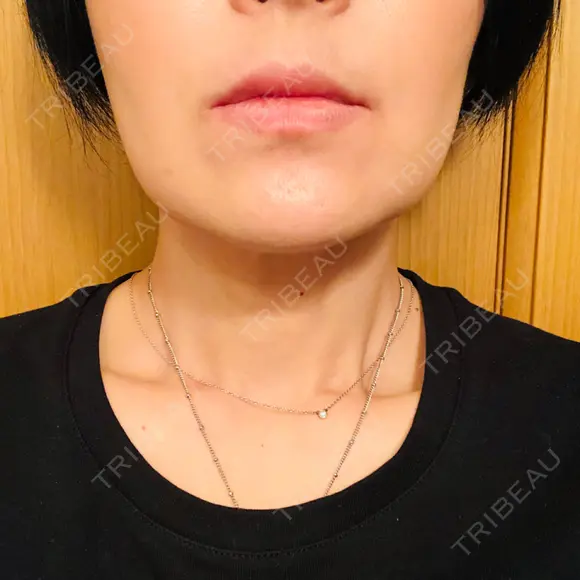 バッカルファット除去 TCB東京中央美容外科 堺院 DAY 6 メイン用