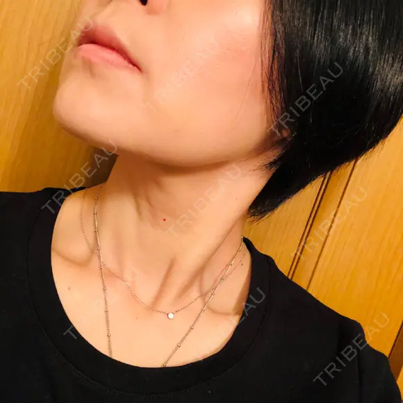 バッカルファット除去 TCB東京中央美容外科 堺院 DAY 6 メイン用