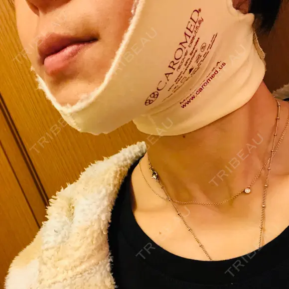 バッカルファット除去 TCB東京中央美容外科 堺院 DAY 6 メイン用