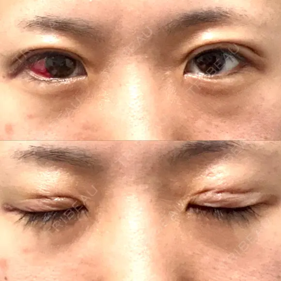 二重埋没 湘南美容クリニック 松山院 DAY 1 メイン用