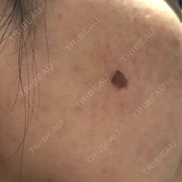 YAGレーザー 新宿美容外科クリニック 横浜院 DAY 5 メイン用