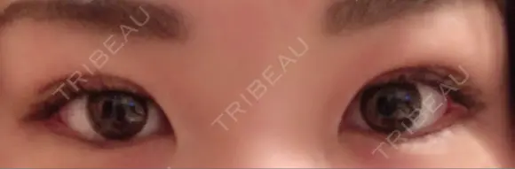 二重埋没 / 上まぶたの脂肪取り TCB東京中央美容外科 江坂院 DAY 9 メイン用