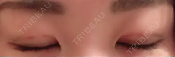 二重埋没 / 上まぶたの脂肪取り TCB東京中央美容外科 江坂院 DAY 9 メイン用