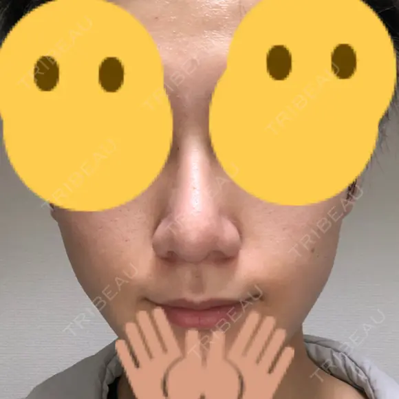 隆鼻術 / 鼻尖形成（切開） / 鼻中隔延長（切開） / 小鼻縮小（切開） / 軟骨移植 / 鼻孔縁挙上 / 鼻尖縮小 Zetith Beauty Clinic 銀座院 DAY 91 メイン用