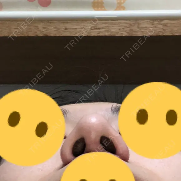 隆鼻術 / 鼻尖形成（切開） / 鼻中隔延長（切開） / 小鼻縮小（切開） / 軟骨移植 / 鼻孔縁挙上 / 鼻尖縮小 Zetith Beauty Clinic 銀座院 DAY 91 メイン用