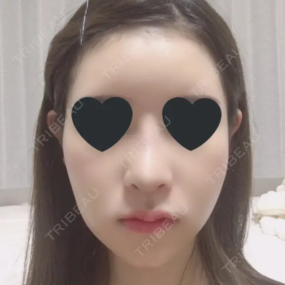 鼻尖形成（切開） / 鼻中隔延長（切開） / 小鼻縮小（切開） / その他（鼻） / 軟骨移植 / 骨切幅寄せ / 眉間プロテーゼ / プロテーゼ除去 / 鼻修正 / 鼻尖縮小 FROM B整形外科 (旧バウム整形外科) DAY 10 メイン用