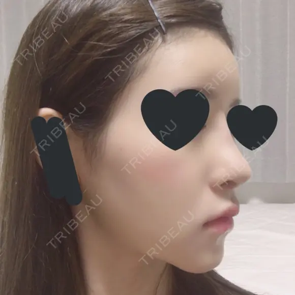 鼻尖形成（切開） / 鼻中隔延長（切開） / 小鼻縮小（切開） / その他（鼻） / 軟骨移植 / 骨切幅寄せ / 眉間プロテーゼ / プロテーゼ除去 / 鼻修正 / 鼻尖縮小 FROM B整形外科 (旧バウム整形外科) DAY 10 メイン用