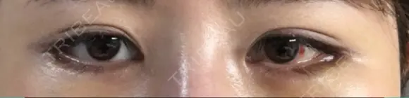 目尻切開 / タレ目形成・グラマラスライン（切開） / 目尻靭帯移動 / その他（目元） FROM B整形外科 (旧バウム整形外科) DAY 6 メイン用