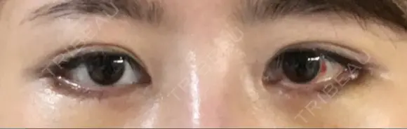 目尻切開 / タレ目形成・グラマラスライン（切開） / 目尻靭帯移動 / その他（目元） FROM B整形外科 (旧バウム整形外科) DAY 8 メイン用