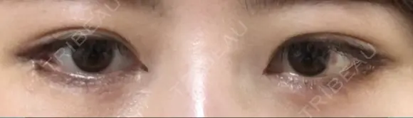 目尻切開 / タレ目形成・グラマラスライン（切開） / 目尻靭帯移動 / その他（目元） FROM B整形外科 (旧バウム整形外科) DAY 12 メイン用