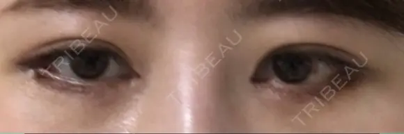 目尻切開 / タレ目形成・グラマラスライン（切開） / 目尻靭帯移動 / その他（目元） FROM B整形外科 (旧バウム整形外科) DAY 13 メイン用