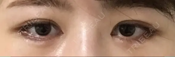 目尻切開 / タレ目形成・グラマラスライン（切開） / 目尻靭帯移動 / その他（目元） FROM B整形外科 (旧バウム整形外科) DAY 23 メイン用