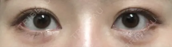 目尻切開 / タレ目形成・グラマラスライン（切開） / 目尻靭帯移動 / その他（目元） FROM B整形外科 (旧バウム整形外科) DAY 56 メイン用