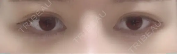 目尻切開 / タレ目形成・グラマラスライン（切開） / 目尻靭帯移動 / その他（目元） FROM B整形外科 (旧バウム整形外科) DAY 57 メイン用