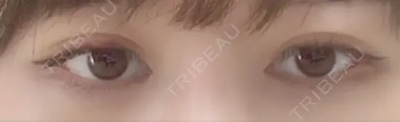 目尻切開 / タレ目形成・グラマラスライン（切開） / 目尻靭帯移動 / その他（目元） FROM B整形外科 (旧バウム整形外科) AFTER メイン用