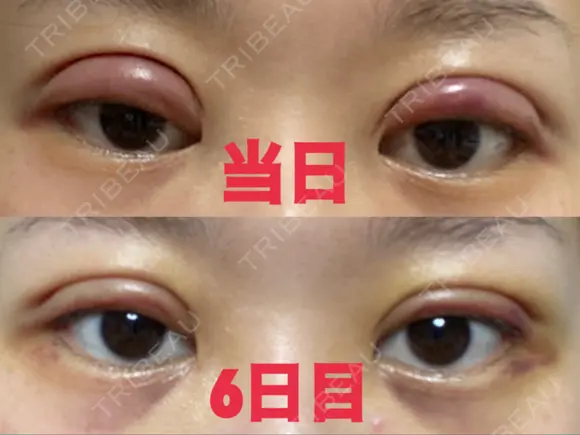 二重切開 こうべ花時計クリニック DAY 6 メイン用