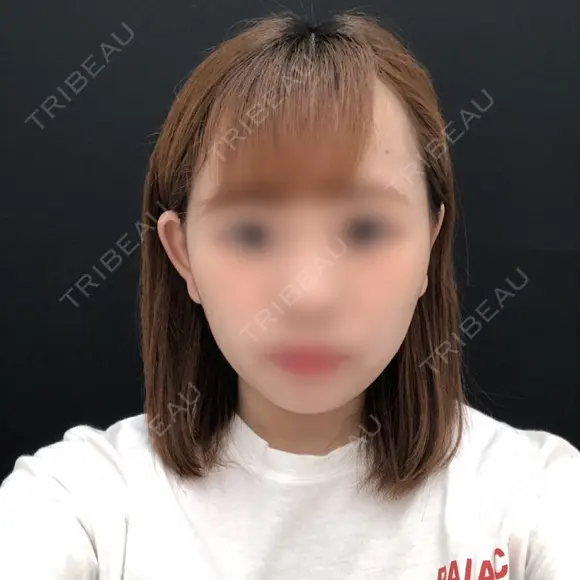 バッカルファット除去 / ボトックス（エラ・小顔） 湘南美容クリニック 秋葉原院 AFTER メイン用