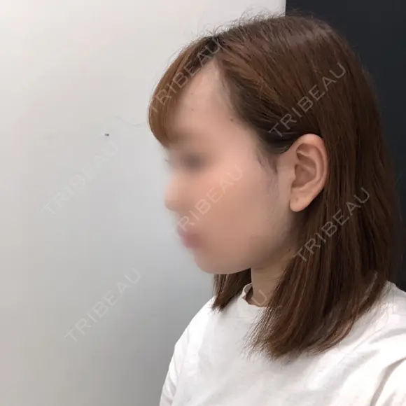 バッカルファット除去 / ボトックス（エラ・小顔） 湘南美容クリニック 秋葉原院 DAY 93 メイン用