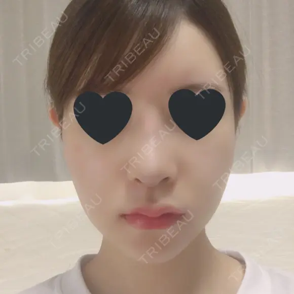 鼻尖形成（切開） / 鼻中隔延長（切開） / 小鼻縮小（切開） / その他（鼻） / 軟骨移植 / 骨切幅寄せ / 眉間プロテーゼ / プロテーゼ除去 / 鼻修正 / 鼻尖縮小 FROM B整形外科 (旧バウム整形外科) DAY 11 メイン用