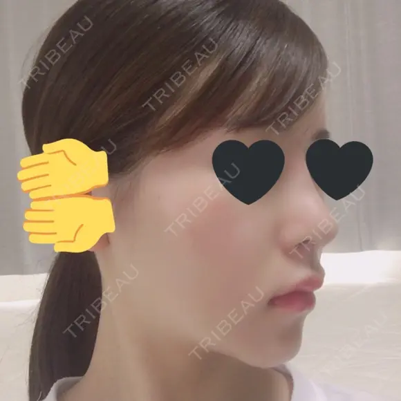 鼻尖形成（切開） / 鼻中隔延長（切開） / 小鼻縮小（切開） / その他（鼻） / 軟骨移植 / 骨切幅寄せ / 眉間プロテーゼ / プロテーゼ除去 / 鼻修正 / 鼻尖縮小 FROM B整形外科 (旧バウム整形外科) DAY 11 メイン用
