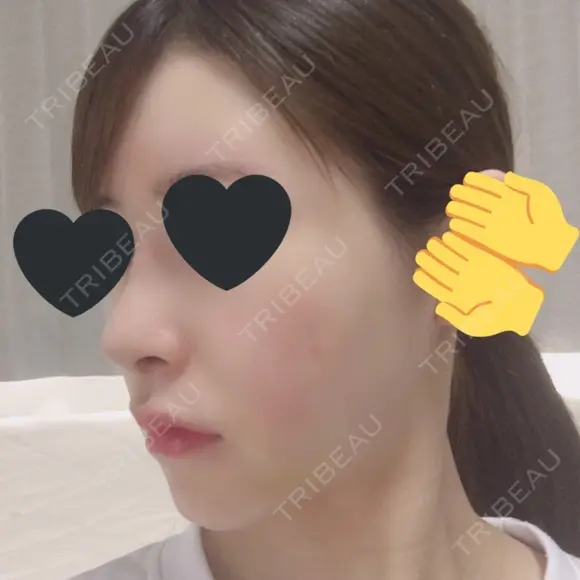 鼻尖形成（切開） / 鼻中隔延長（切開） / 小鼻縮小（切開） / その他（鼻） / 軟骨移植 / 骨切幅寄せ / 眉間プロテーゼ / プロテーゼ除去 / 鼻修正 / 鼻尖縮小 FROM B整形外科 (旧バウム整形外科) DAY 11 メイン用