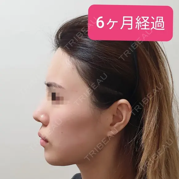 あごプロテーゼ / 骨削り（エラ） / 骨削り（頬） GNG美容外科 DAY 183 メイン用