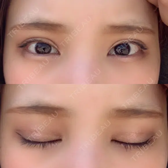 二重埋没 ビスポーククリニック 福岡院 DAY 48 メイン用