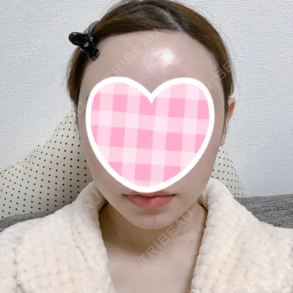 糸リフト / 骨削り（頬） / 脂肪吸引（顔） RG整形外科（旧リオン整形外科） AFTER メイン用