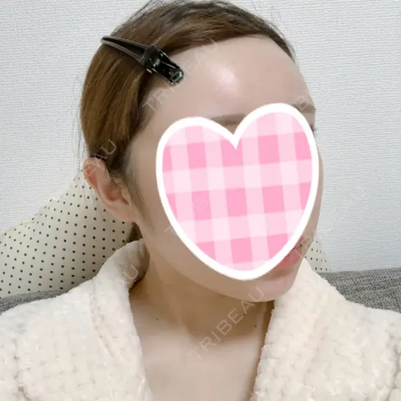 糸リフト / 骨削り（頬） / 脂肪吸引（顔） RG整形外科（旧リオン整形外科） DAY 90 メイン用