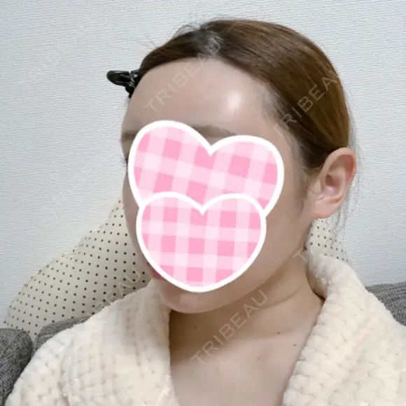 糸リフト / 骨削り（頬） / 脂肪吸引（顔） RG整形外科（旧リオン整形外科） DAY 90 メイン用