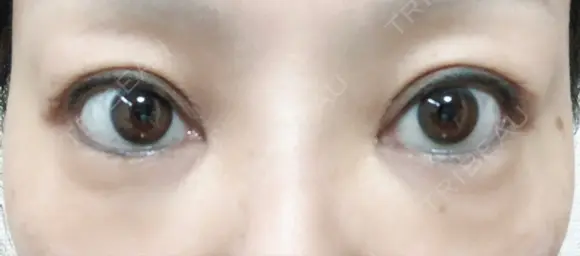 下まぶたたるみ取り セオリークリニック DAY 60 メイン用